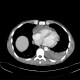 Stab wound of thorax, internal mammary artery and aortic arch, mediastinal hemorrhage, hemothorax: CT - Computed tomography